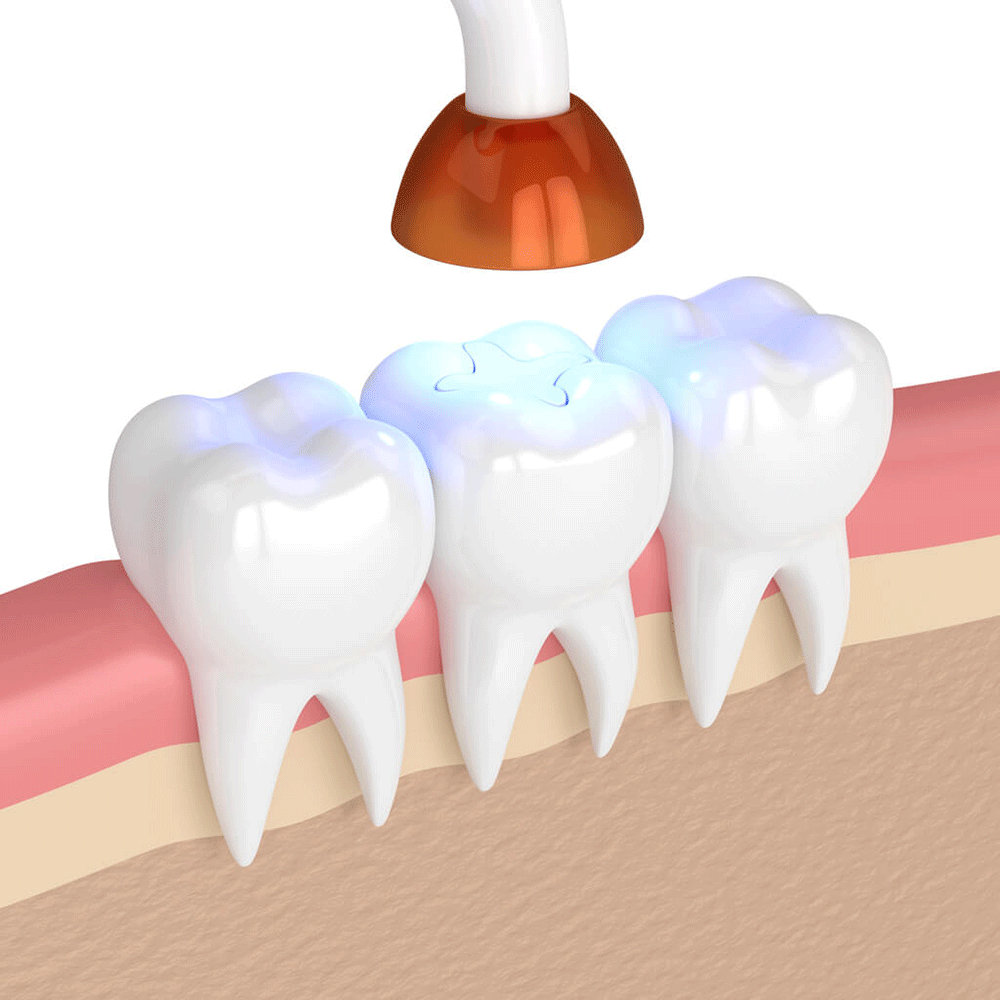 tooth fillings illustration